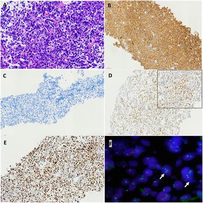 Case report: Circulating tumor DNA technology displays temporal and spatial heterogeneity in Waldenström macroglobulinemia during treatment with BTK inhibitors